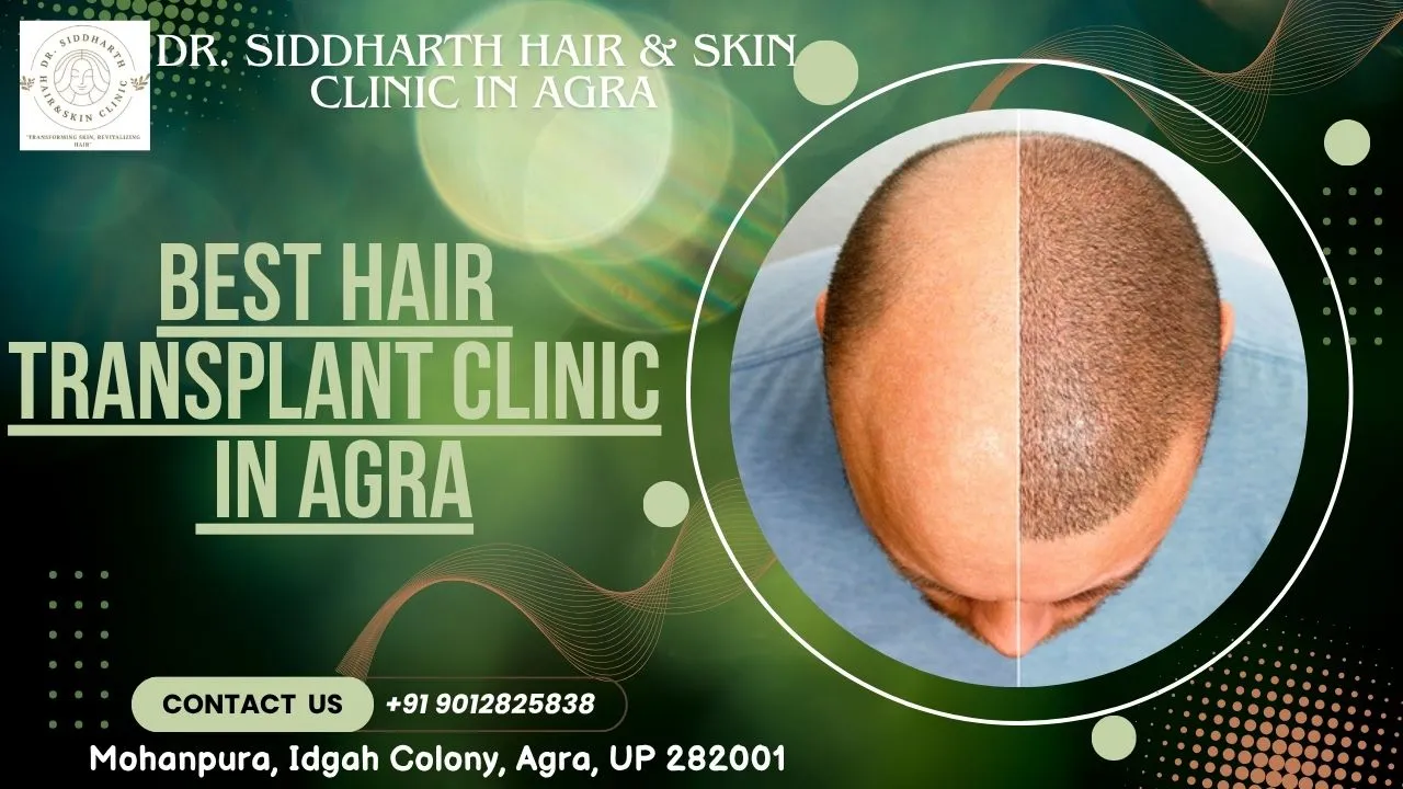 You are currently viewing Best Hair Transplant Clinic in Agra – Regain Your Confidence with Dr. Siddharth