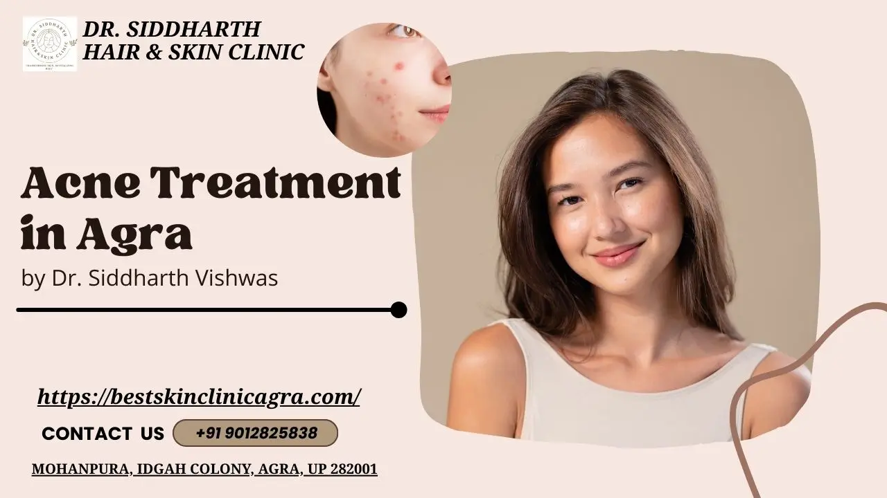 Read more about the article Acne Treatment in Agra: Clear Skin Starts at Best Skin Clinic