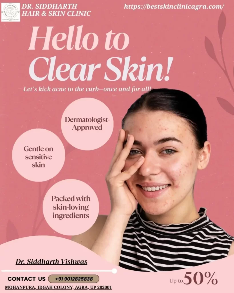 Best Acne Treatment in Agra