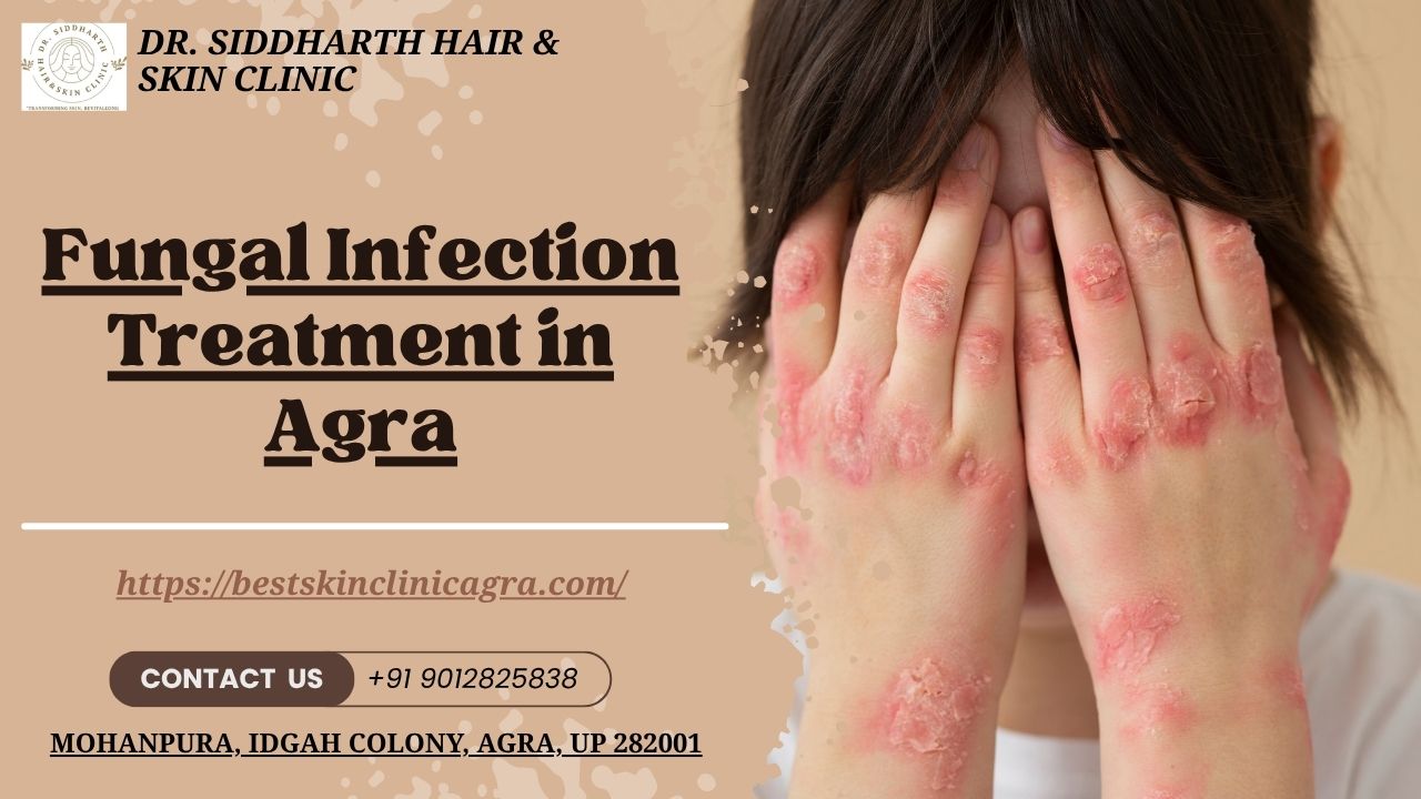Read more about the article Fungal Infection Treatment in Agra – Dr. Siddharth Hair & Skin Clinic